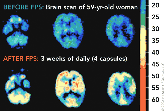 PET image of a 59-year-old female’s brain. The color scale indicates regional glucose metabolism at
                   three brain levels, red is most intense and tertiary is least. Upper: before Flavay Plus; Lower:
                   after Flavay Plus daily for three weeks.